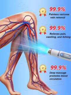 Терапия Blue Light Laser для лечения варикозного расширения вен, улучшенная версия третьего поколения.